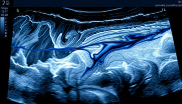 Understanding Preserved Muscle Architecture: Insights from Ultrasound Imaging