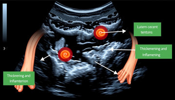 Understanding Ultrasound Findings: What Tendon Thickening Means for Your Health