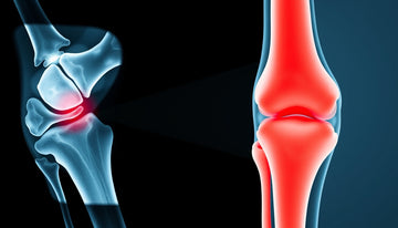 Understanding X-Ray Results: What Osteoarthritic Changes Indicate for Your Joint Health