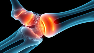 Understanding X-Ray Results: What Mild Degenerative Changes Reveal About Your Joint Health