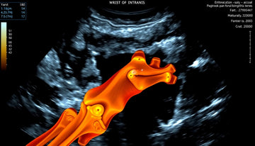 Understanding Wrist Tenosynovitis: What Your Ultrasound Results Reveal